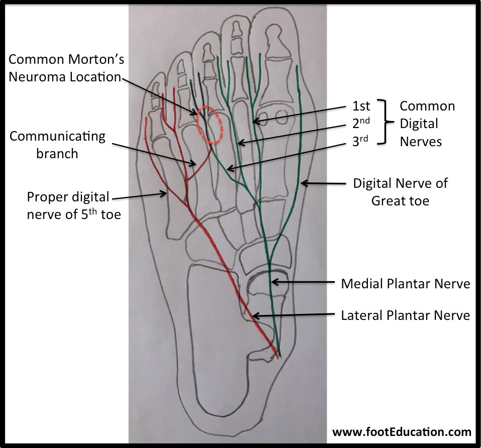 Morton's neuroma anatomy