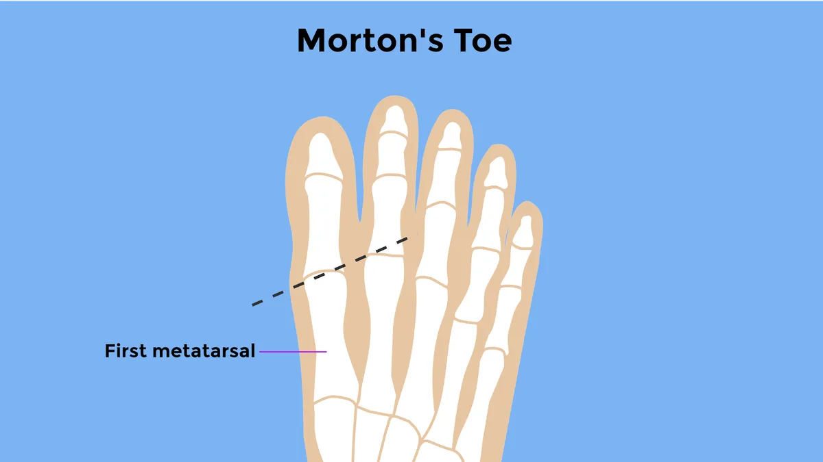 Morton's toe