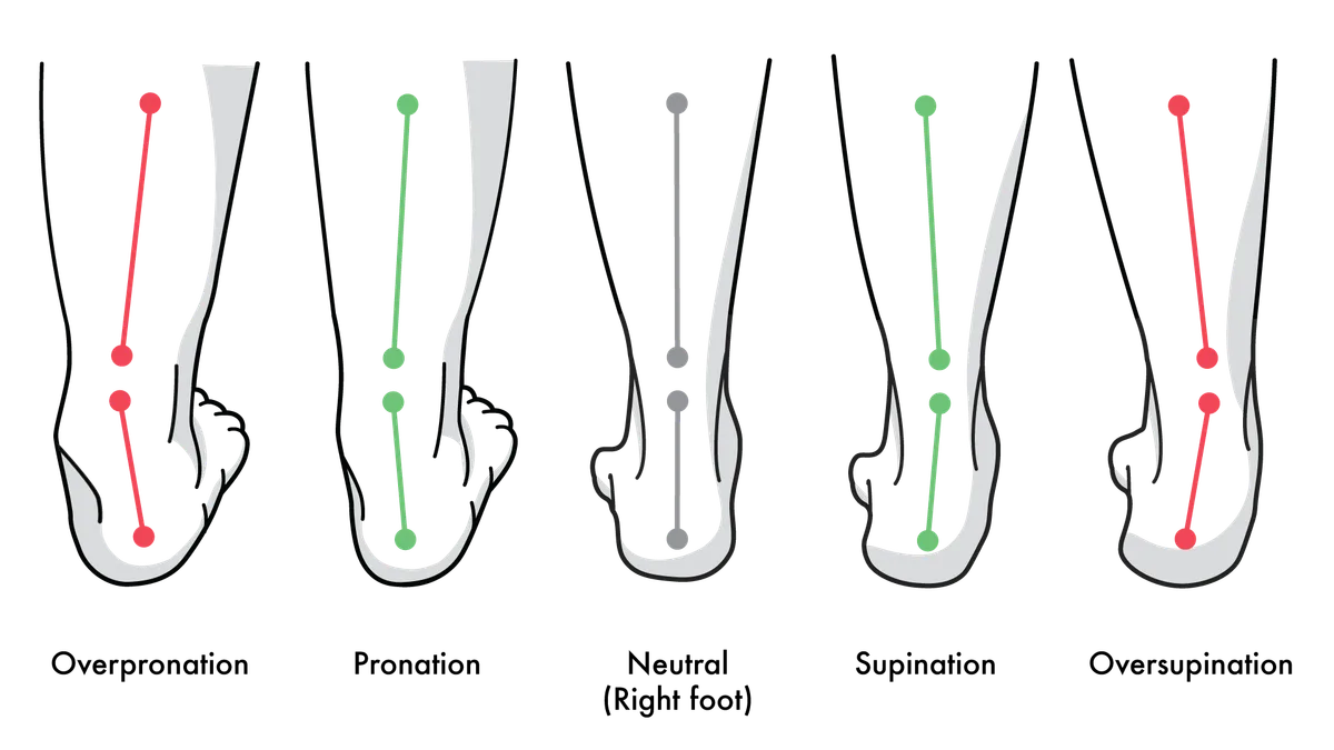 subtalar joint overpronation